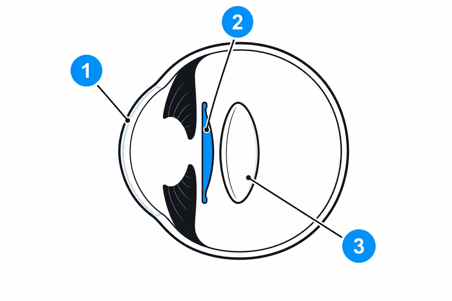 Illustrated cross-section of an eye from the side. 1: the clear cornea at the front. 2: the blue EVO ICL behind the iris and in front of the natural lens, with a small gap between them. 3: the eye's own natural lens, still in place.